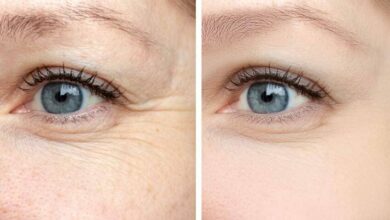 filler con acido ialuronico per occhiaie